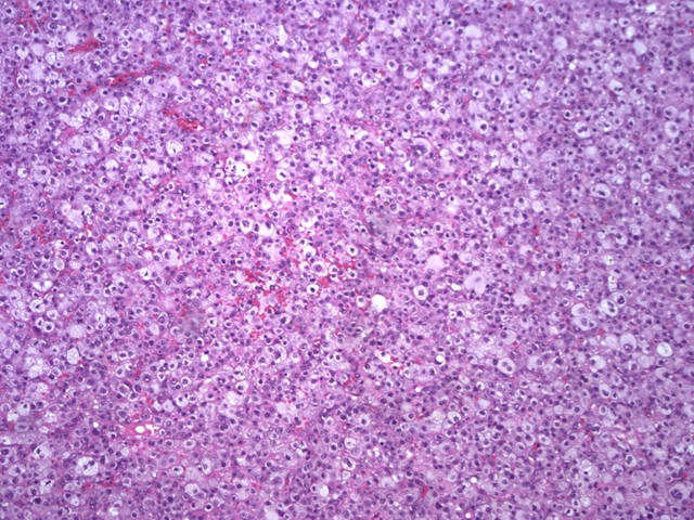 Melanoma 10X - <div style=